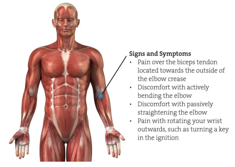 symptoms of biceps tightness