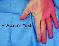 The Allen Test for Blood Flow