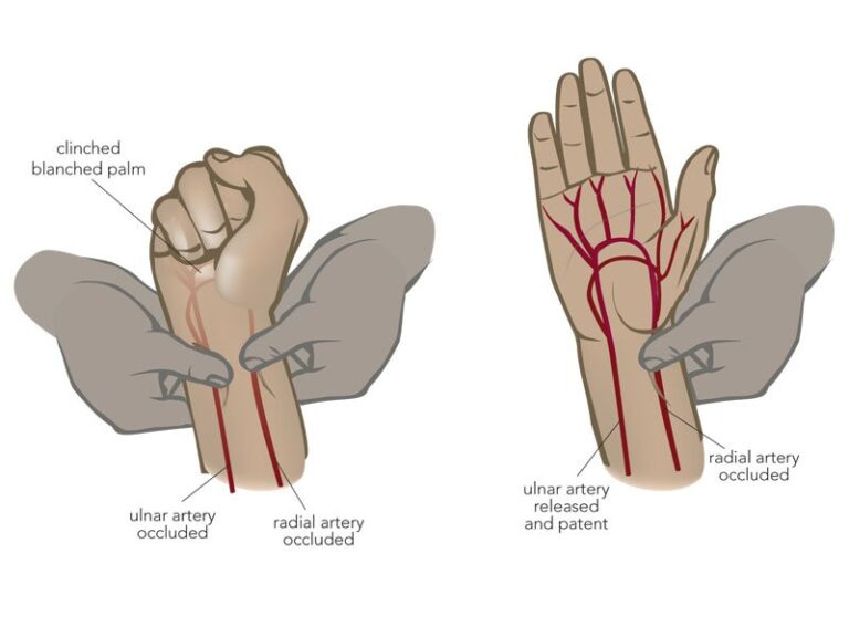 Testing Blood Circulation The Allen Test for Blood Flow: - Mobile Physiotherapy Clinic