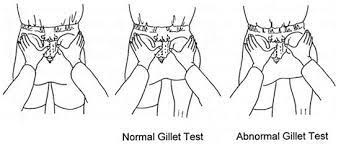 Gillet's test
