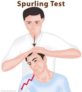 Spurling's Test: - Mobile Physiotherapy Clinic