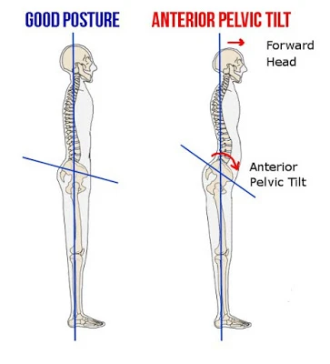 anterior pelvic tilt