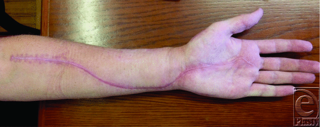 Compartment Syndrome of the forearm
