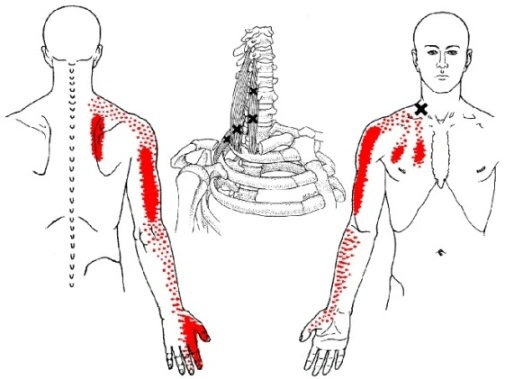 Trigger points in the scalene muscles