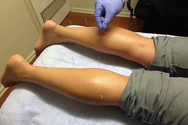 dry needling in calf muscles
