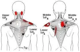 Trigger Point Therapy - Treating the Trapezius Muscle