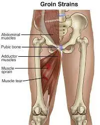groin muscle strain