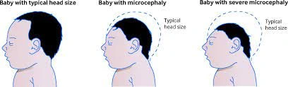 microencephaly