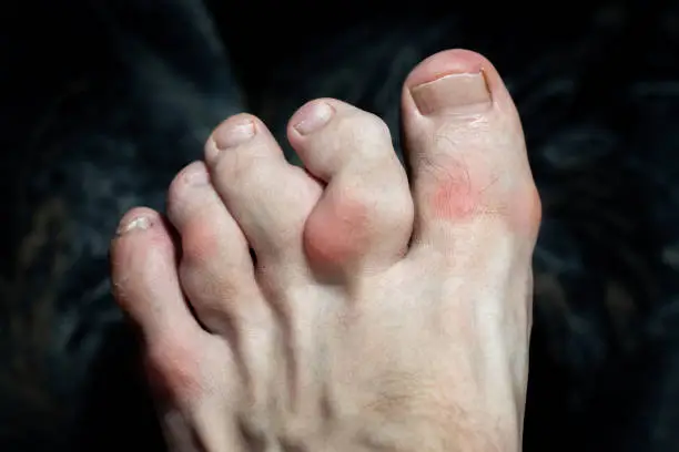 Arthritis-in-toes