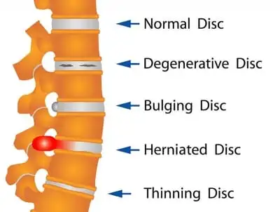 How Many Disc In Your Back