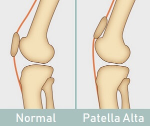 Patella Alta - Cause, Symptoms, Treatment, Exercise