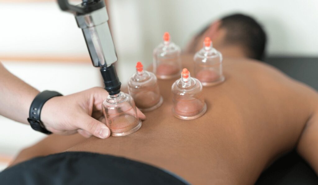 Procedure of cupping
