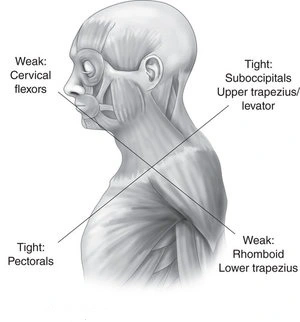 Forward head posture