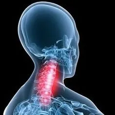 Arthritis of neck