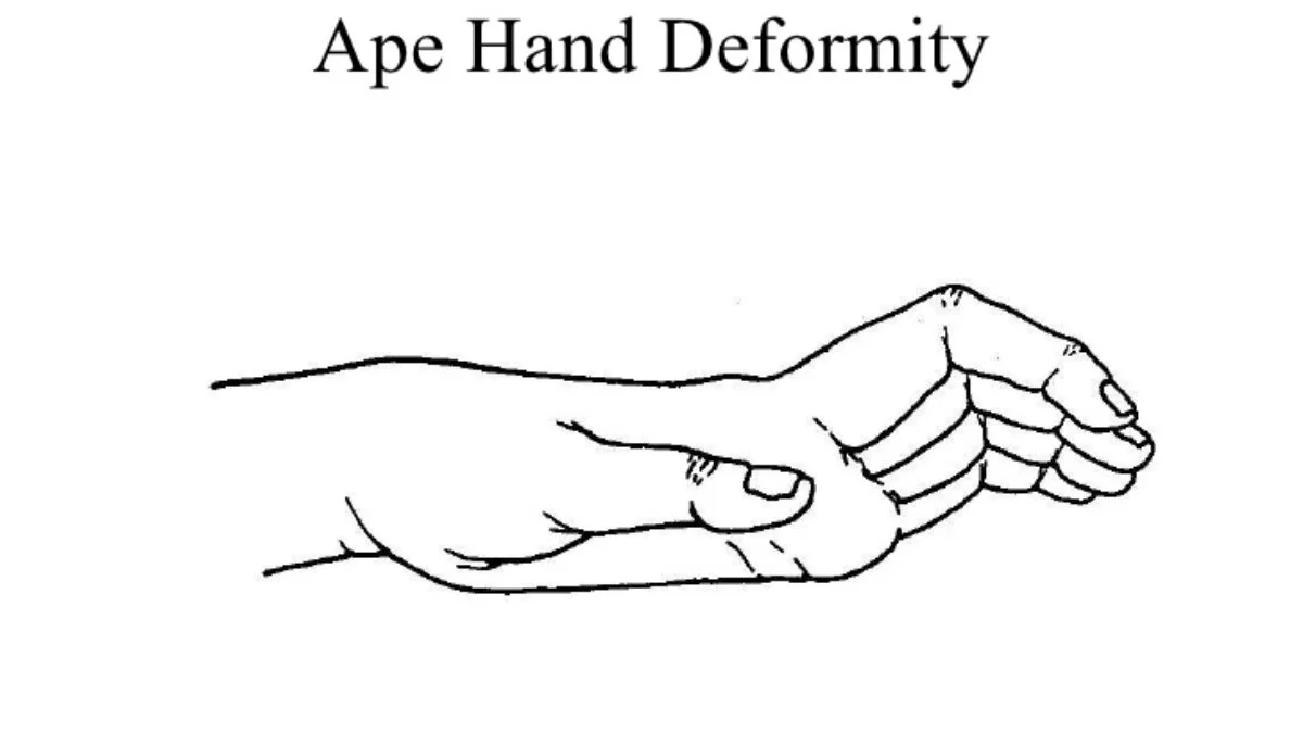 Ape hand deformity