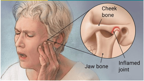 Arthritis of the Temporomandibular Joint
