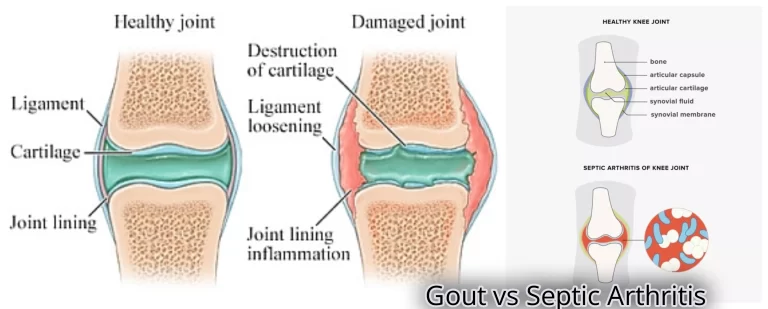 Gout vs Septic Arthritis