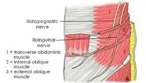 ilioinguinal nerve block