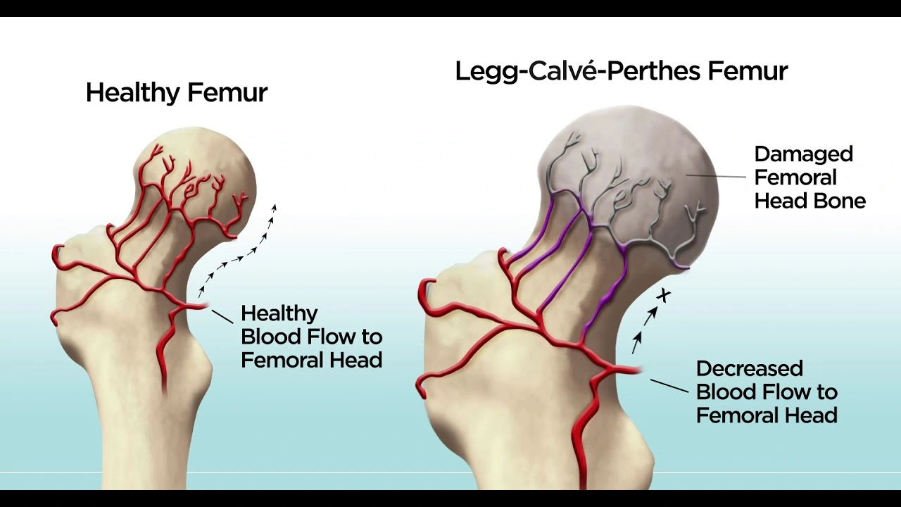 slipped capital femoral epiphysis vs legg calve perthes disease