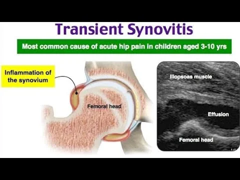 Transient synovitis