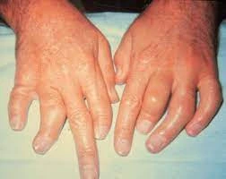 Arthritis mutilans