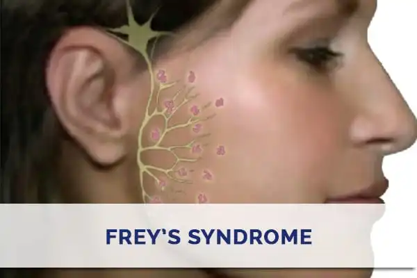 Frey’s syndrome