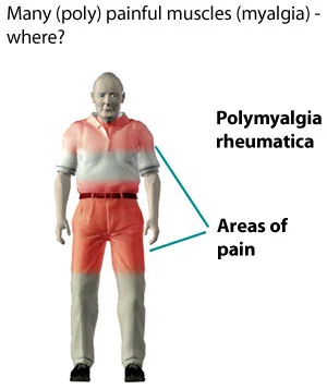 Polymyalgia Rheumatica
