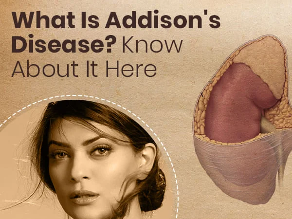 Addison's disease