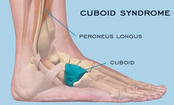 Cuboid syndrome