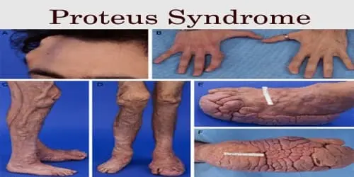 Proteus-Syndrome