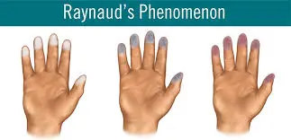 Raynaud_s-phenomenon