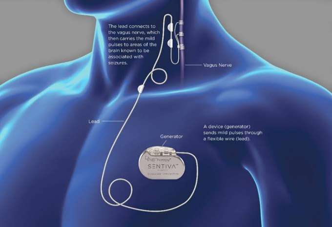 Placement of vagus nerve stimulation device. As illustrated in the