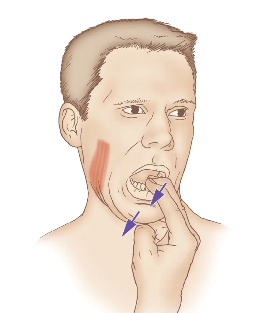 Medial pterygoid stretching