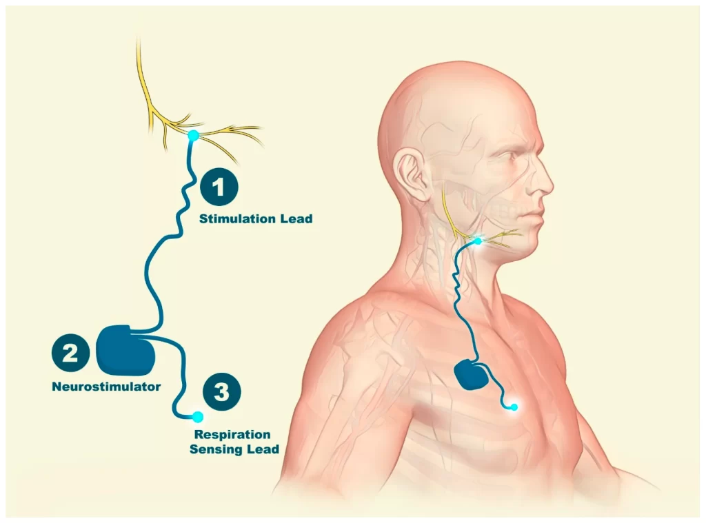 Hypoglossal nerve stimulation