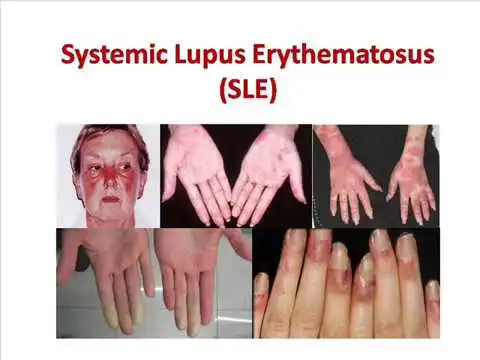 systemic-lupus-erythematosus