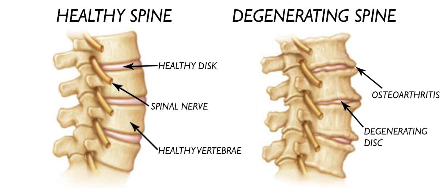 Cervical Degenerative Disc Disease Cddd Physical Therapy