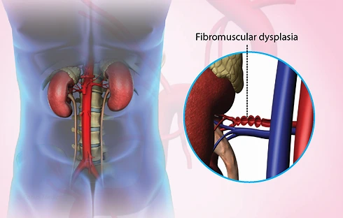 Fibromuscular Displasia