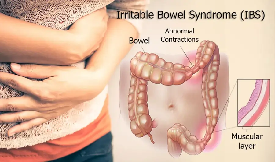 Irritable bowel syndrome (IBS)