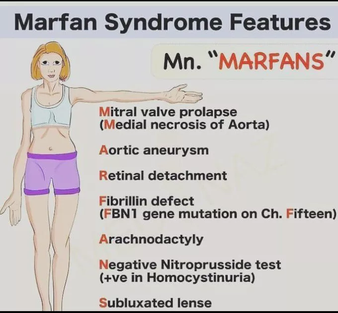Marfan syndrome - Cause, Symptoms, Treatment - Mobile Physio