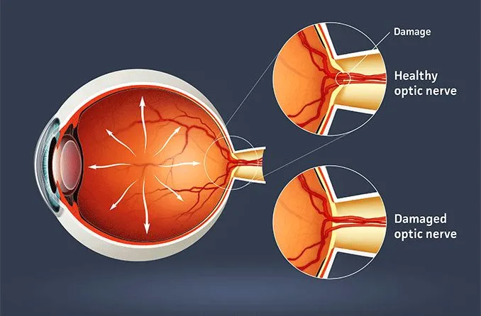 optic nerve