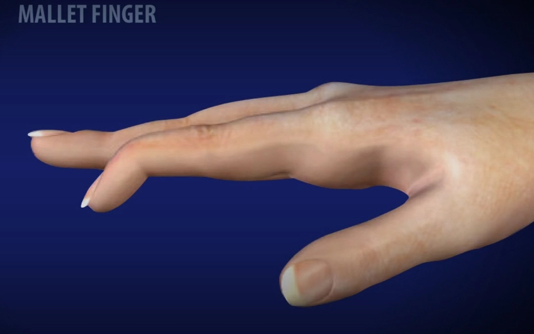 Mallet-finger