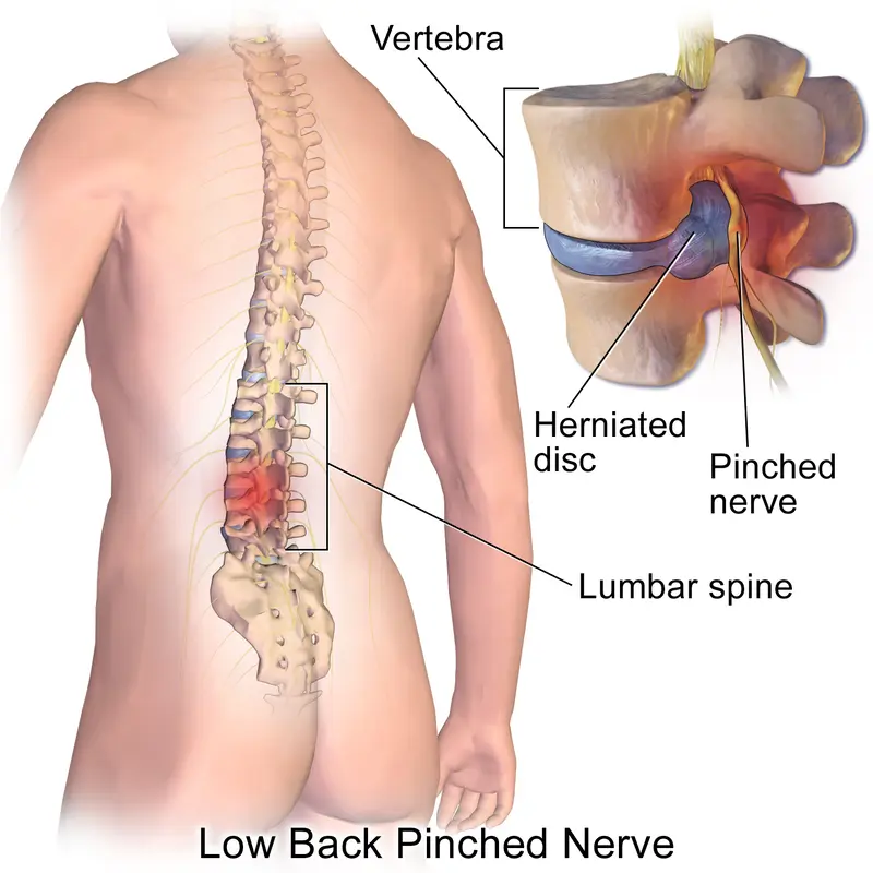 Pinched nerve in lower back