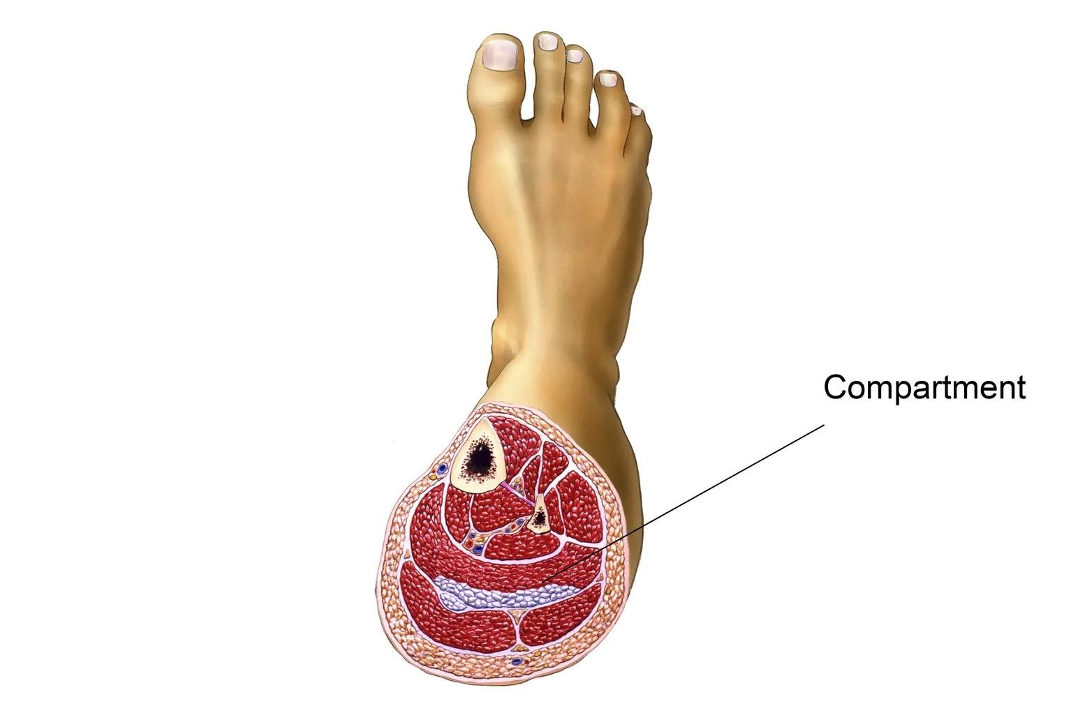 chronic exertional compartment syndrome