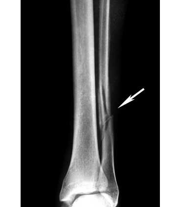 X-ray of fibula fracture