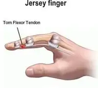 Jersey’s finger:
