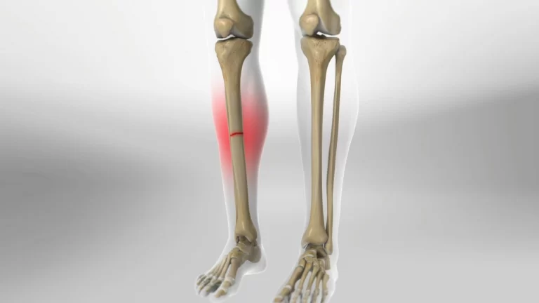 Tibia Fracture