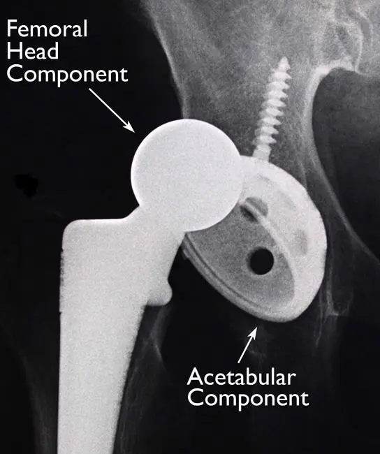 Hip-implant-dislocation