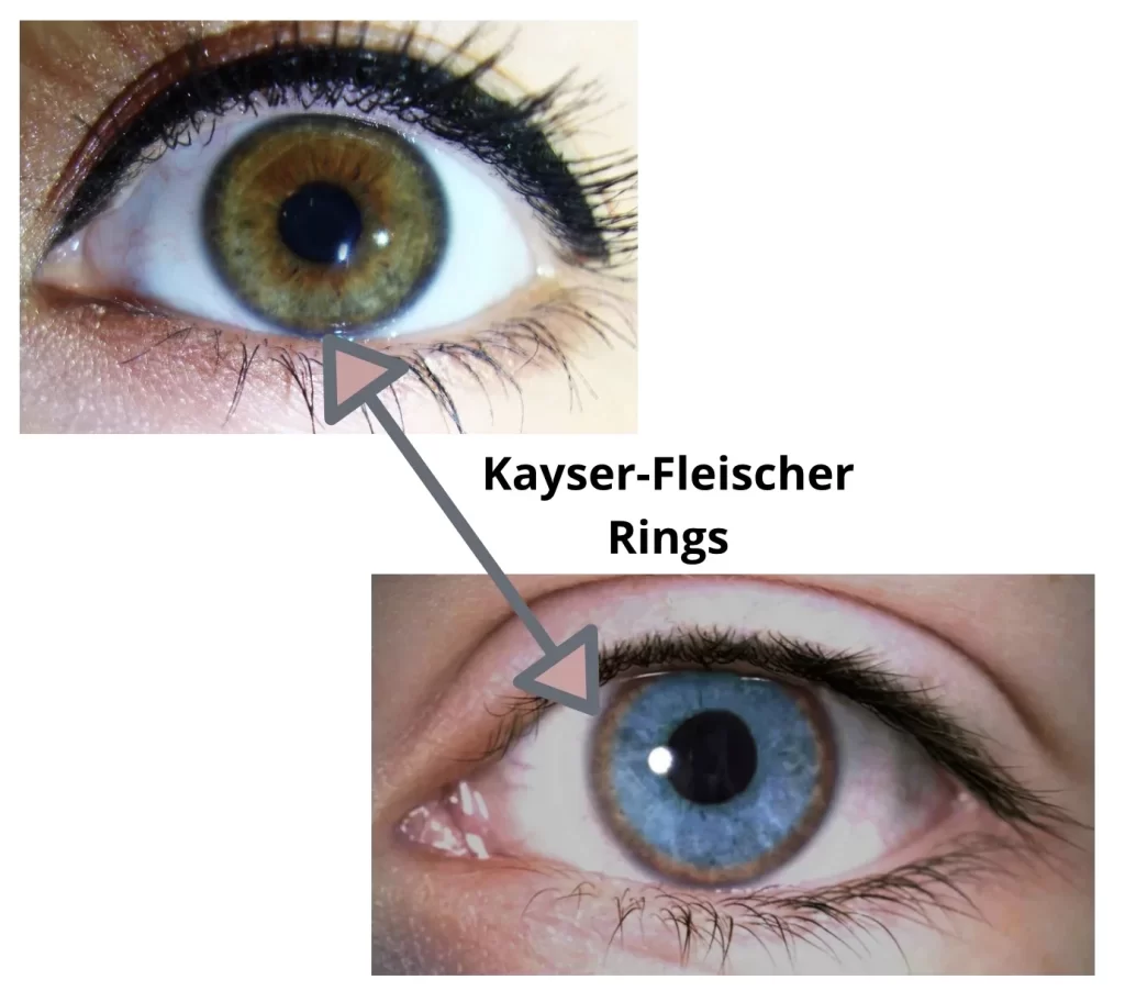 Kayser-Fleischer-Ring