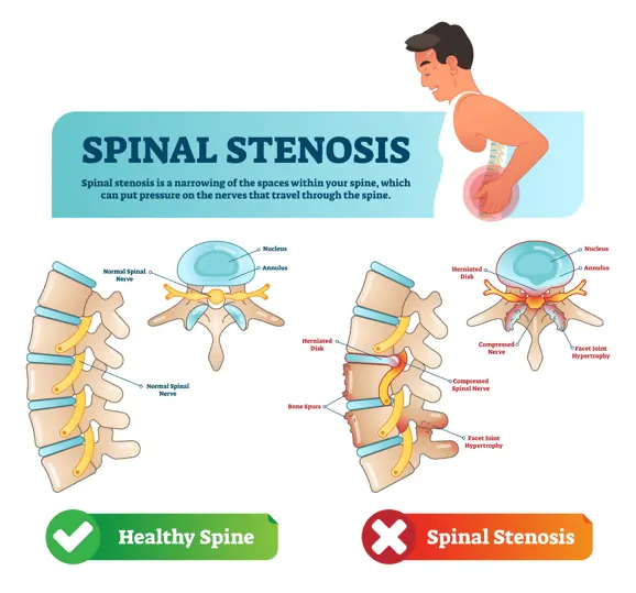 Lumbar Spinal Stenosis