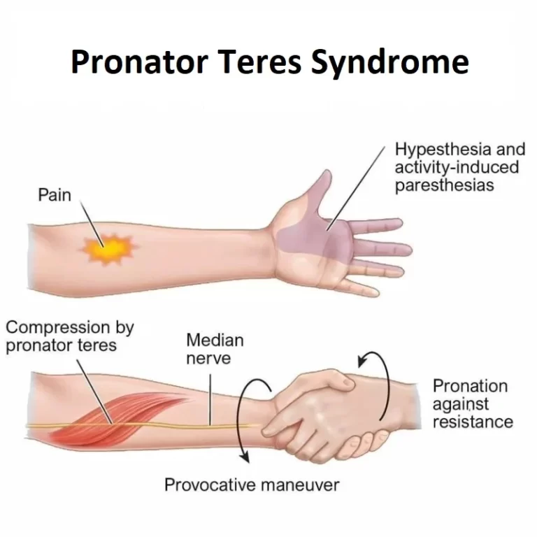 Pronator Teres Syndrome (PTS)